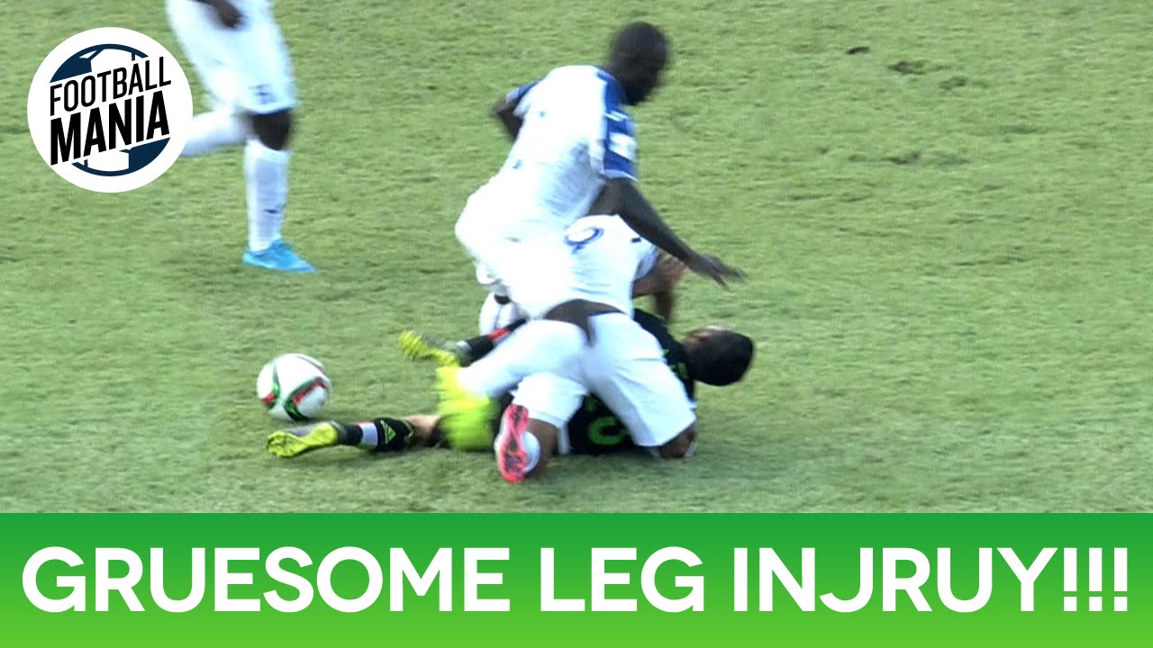 One of the worst leg injuries you will ever see in any sport