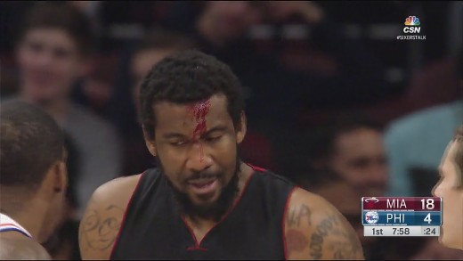 Amar’e Stoudemire gets a nasty cut on his forehead