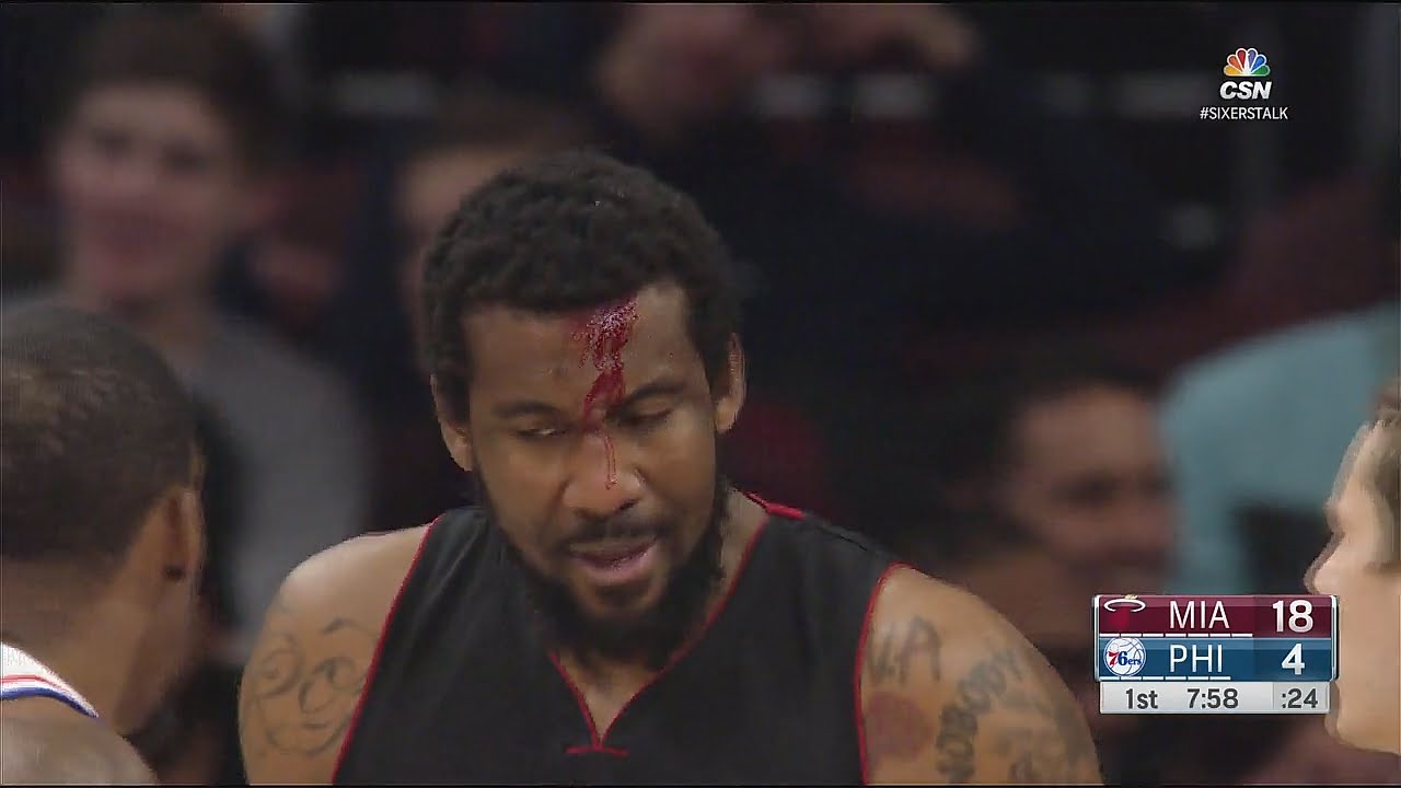 Amar'e Stoudemire gets a nasty cut on his forehead